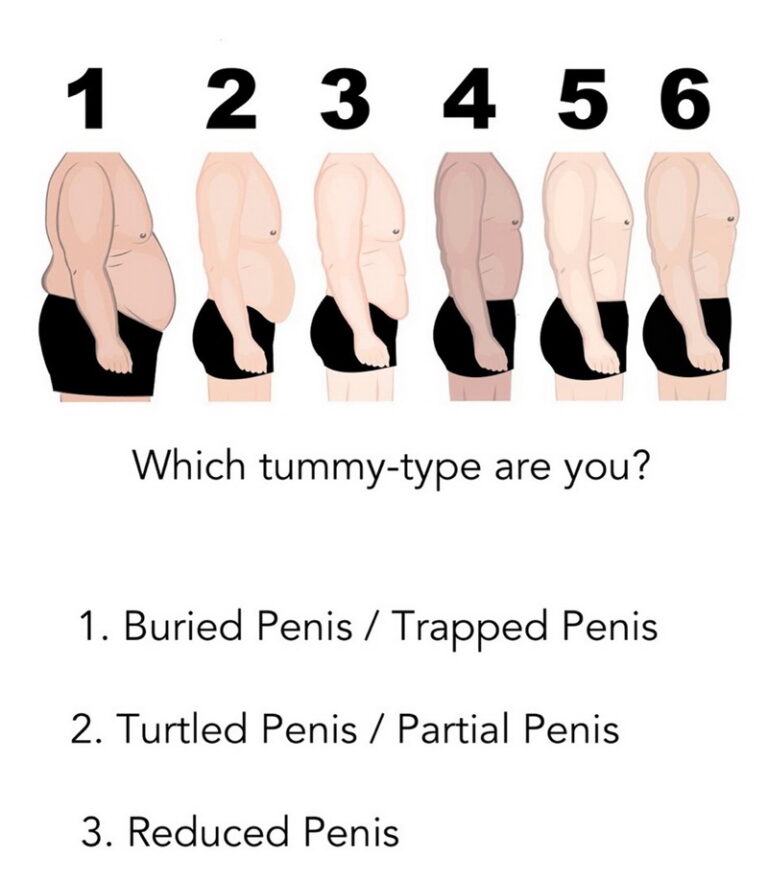 Buried Penis Syndrome Treatment Surgery Correction Average Size