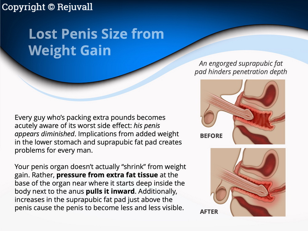 Penis Enlargement After Weight Gain - Rejuvall